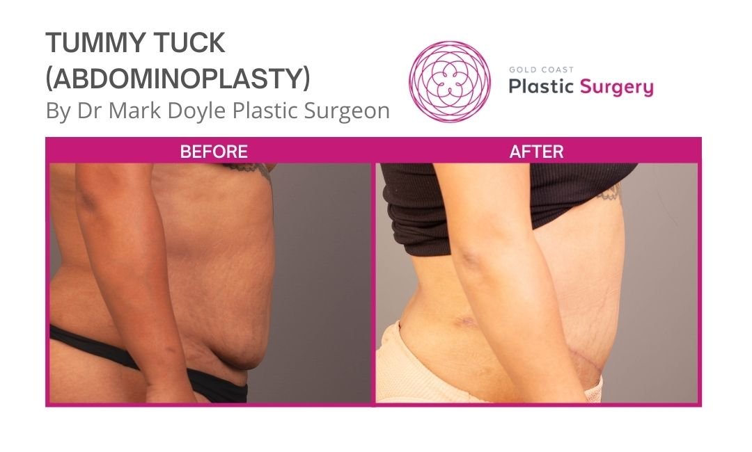 before and after abdominoplasty surgery