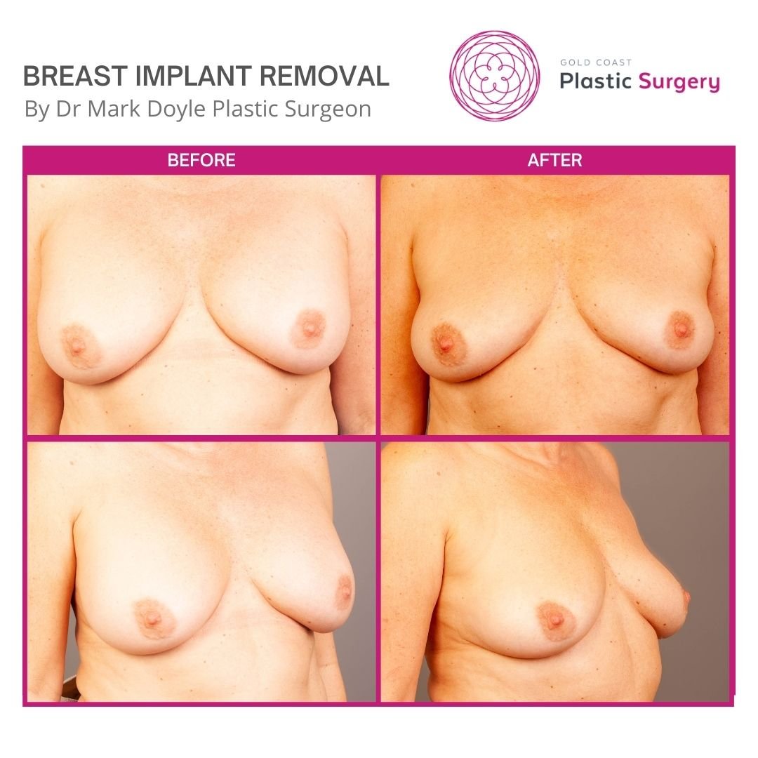 before after breast implant removal