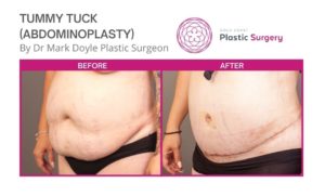 before and after images of tummy tuck surgery