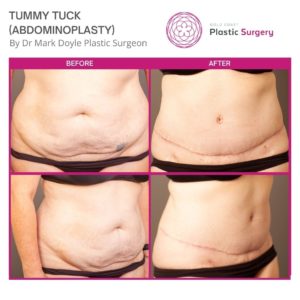 flat tummy surgery before and after