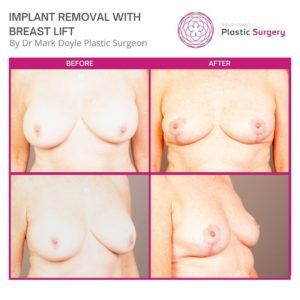 implant removal and uplift photos
