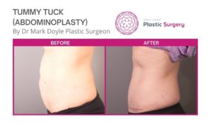 tummy tuck photos before after
