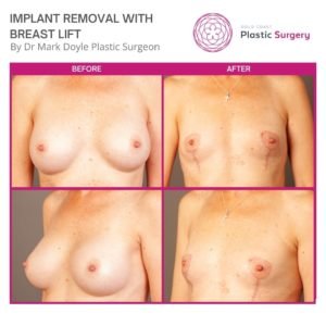 uplift after breast implant removal photos