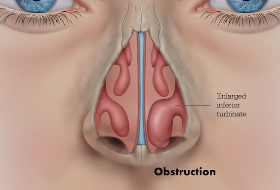 nasal-obstruction-enlarged-turbinates