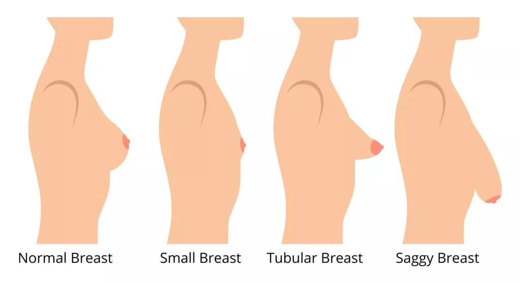Dr Craig Layt - Tuberous breasts are a congenital abnormality of the breasts  and can be characterised by breasts that appear more conical in shape, as  opposed to round. While not a