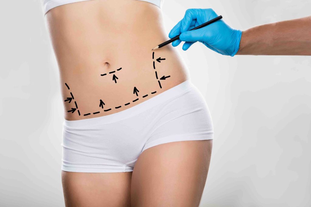 mini-tummy-tuck