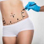 mini-tummy-tuck