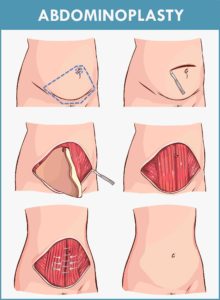 tummy tuck for external fat