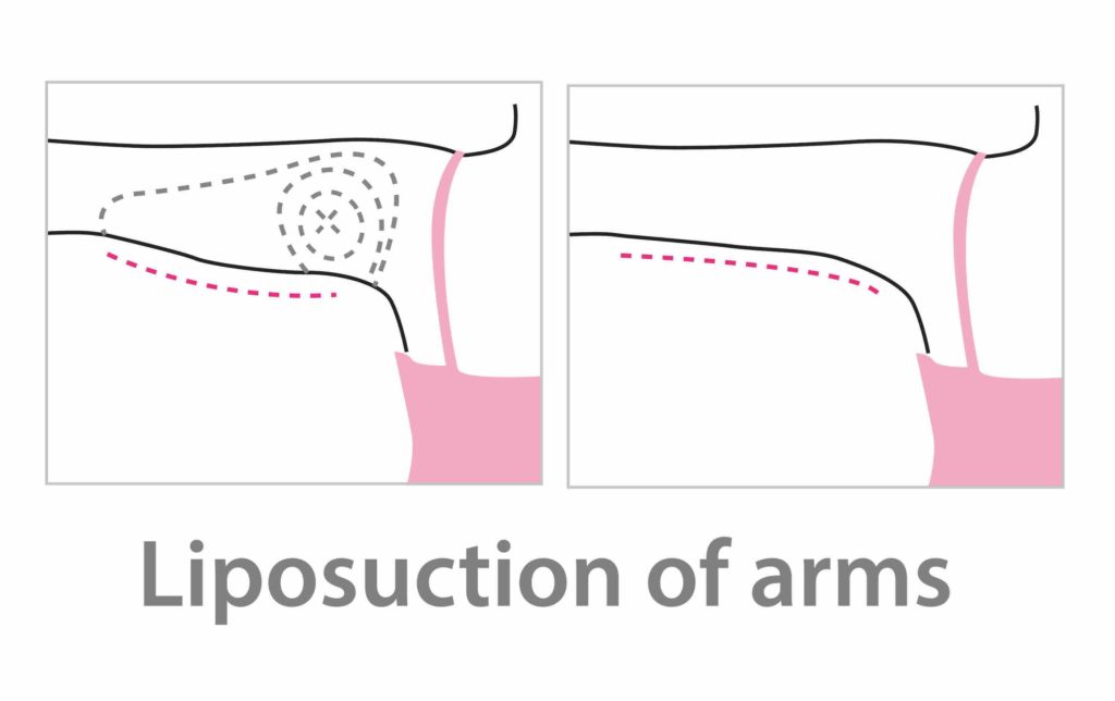 arm-liposuction