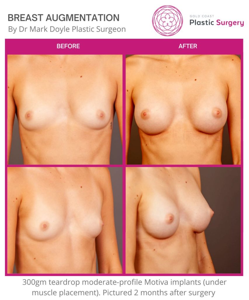boob job breast augmentation before and after images