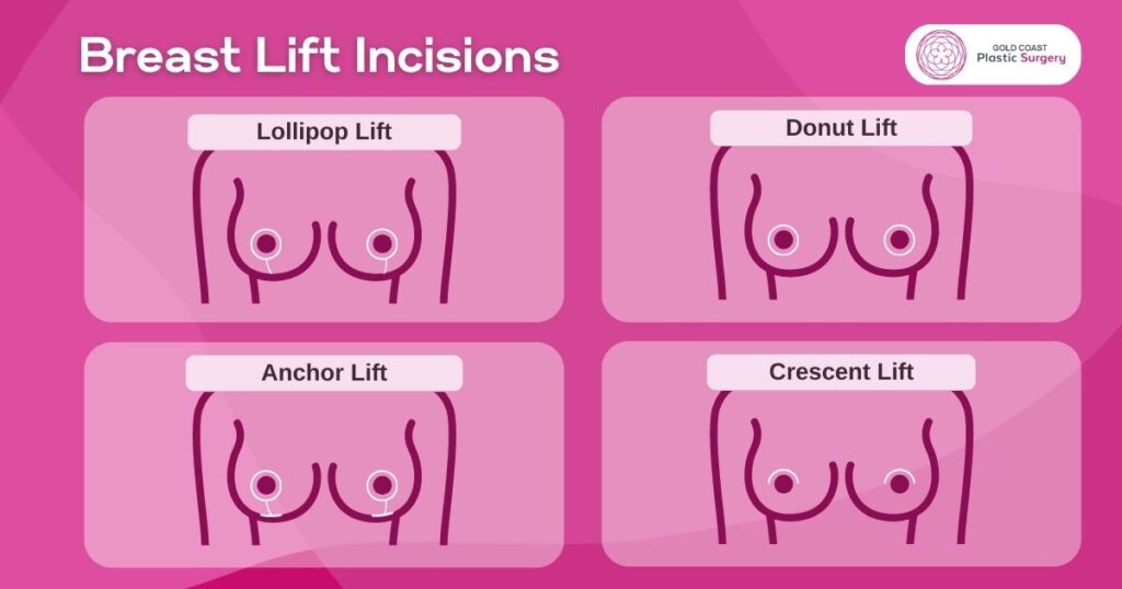 breast lift incisions