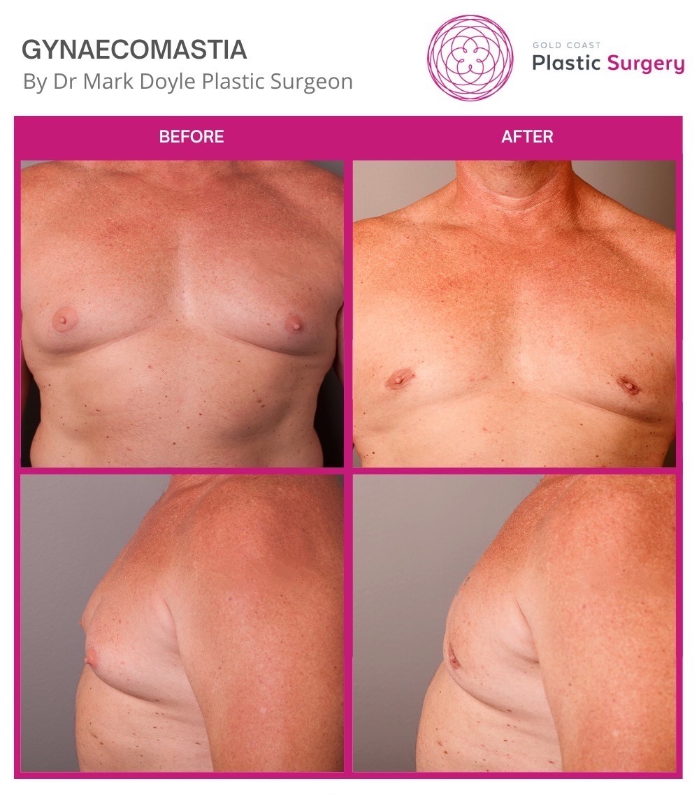 before and after gynaecomastia