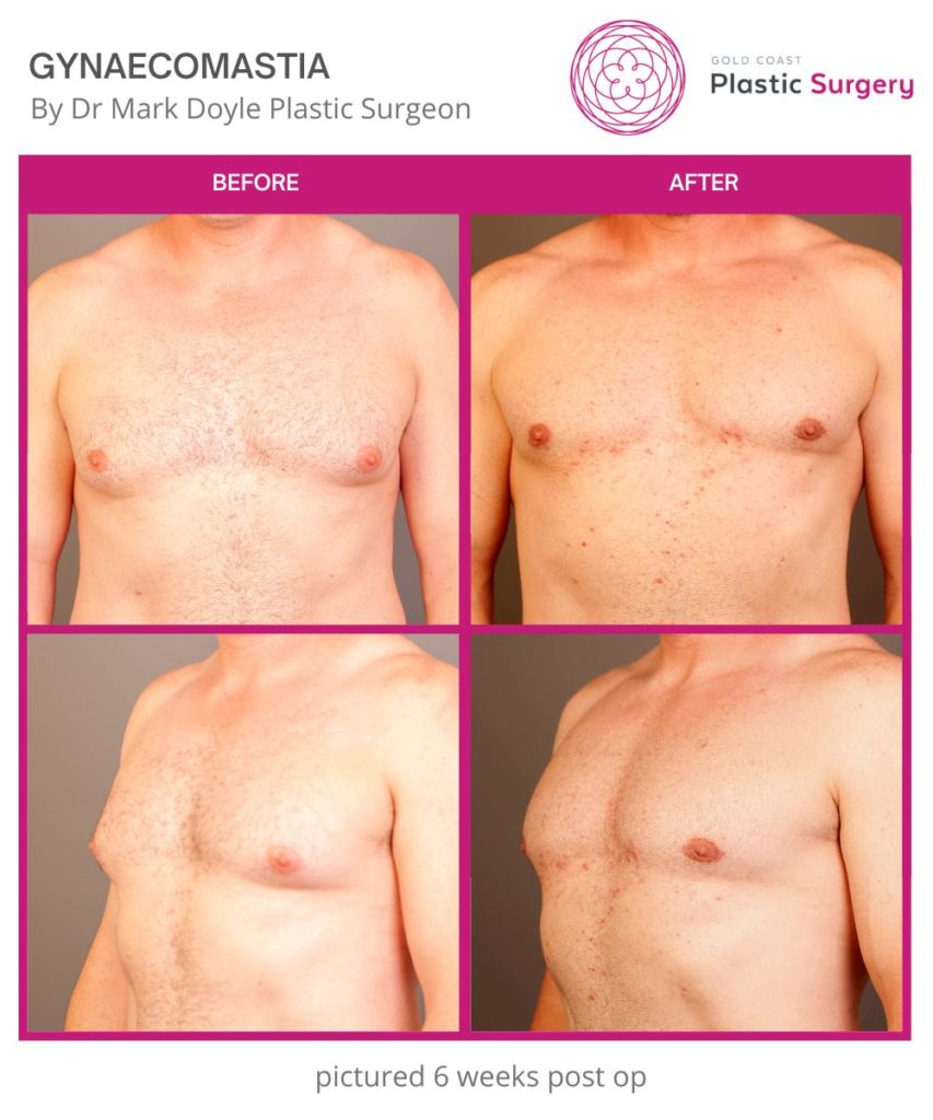 gynaecomastia-images