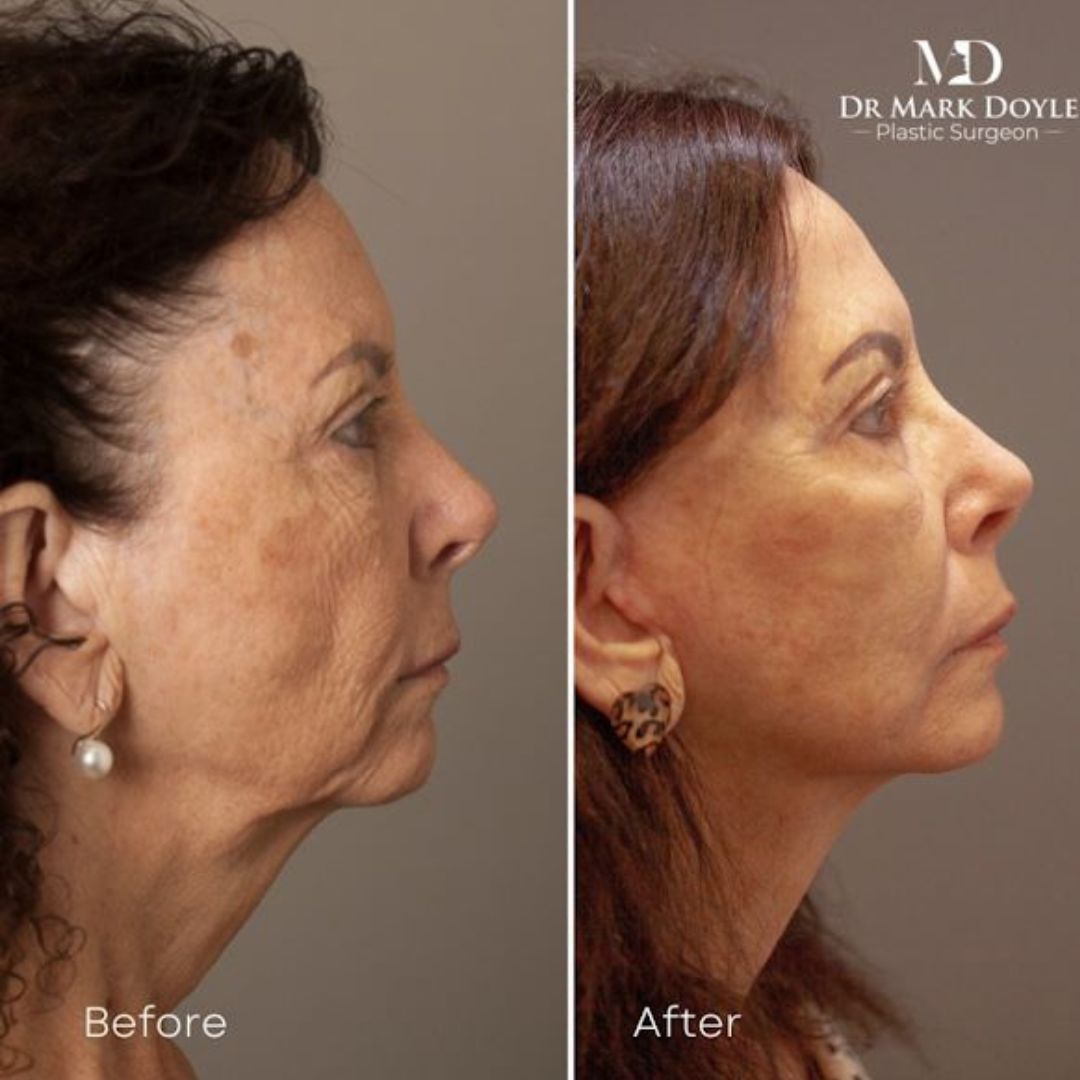 Frown Lines and Forehead Wrinkles Prevention and Treatment