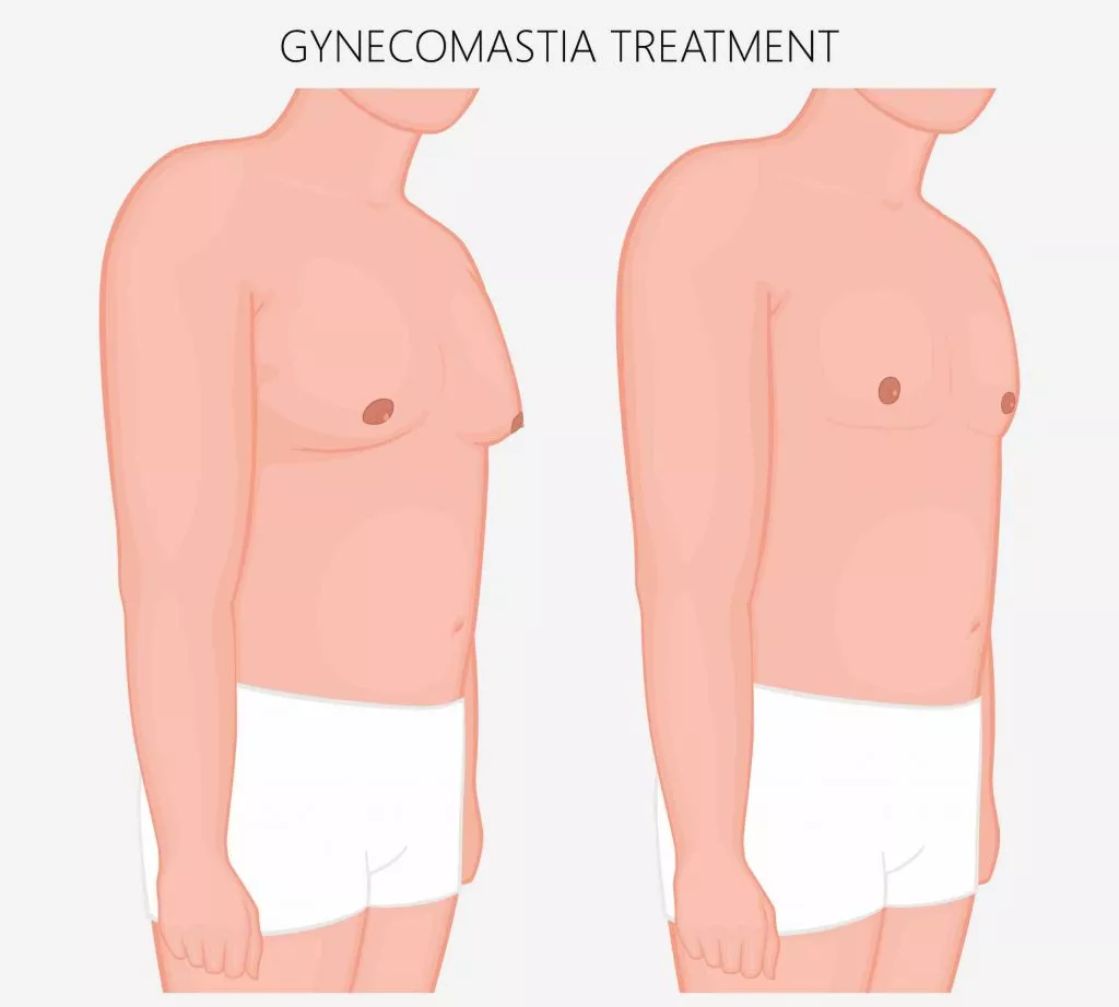 gynecomastia treatments
