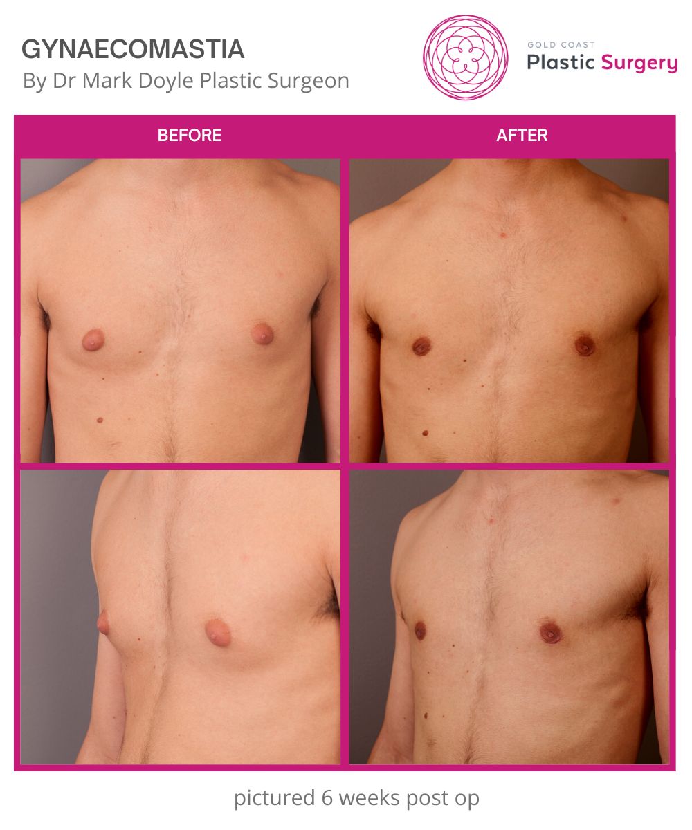 Belt Lipectomy with Bilateral Excision of Gynecomastia and Liposuction of  the chest