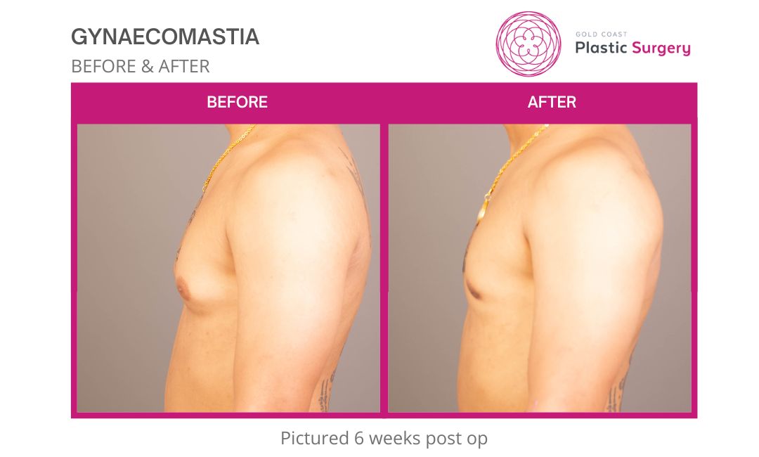 male breast reduction images