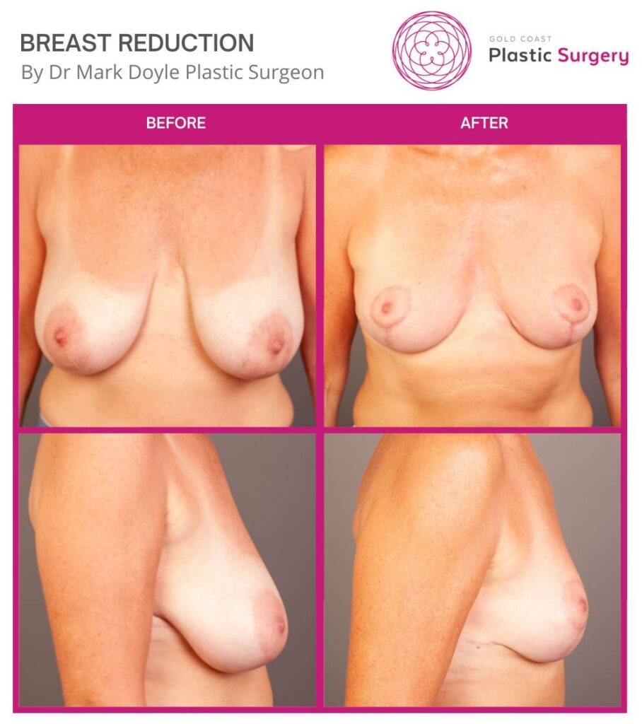 breast reduction scars after 6 months