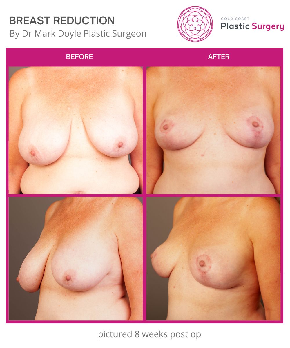 BREAST REDUCTION 7