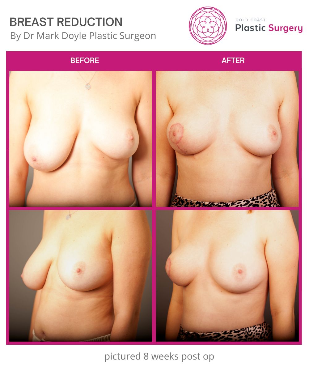 BREAST REDUCTION 9