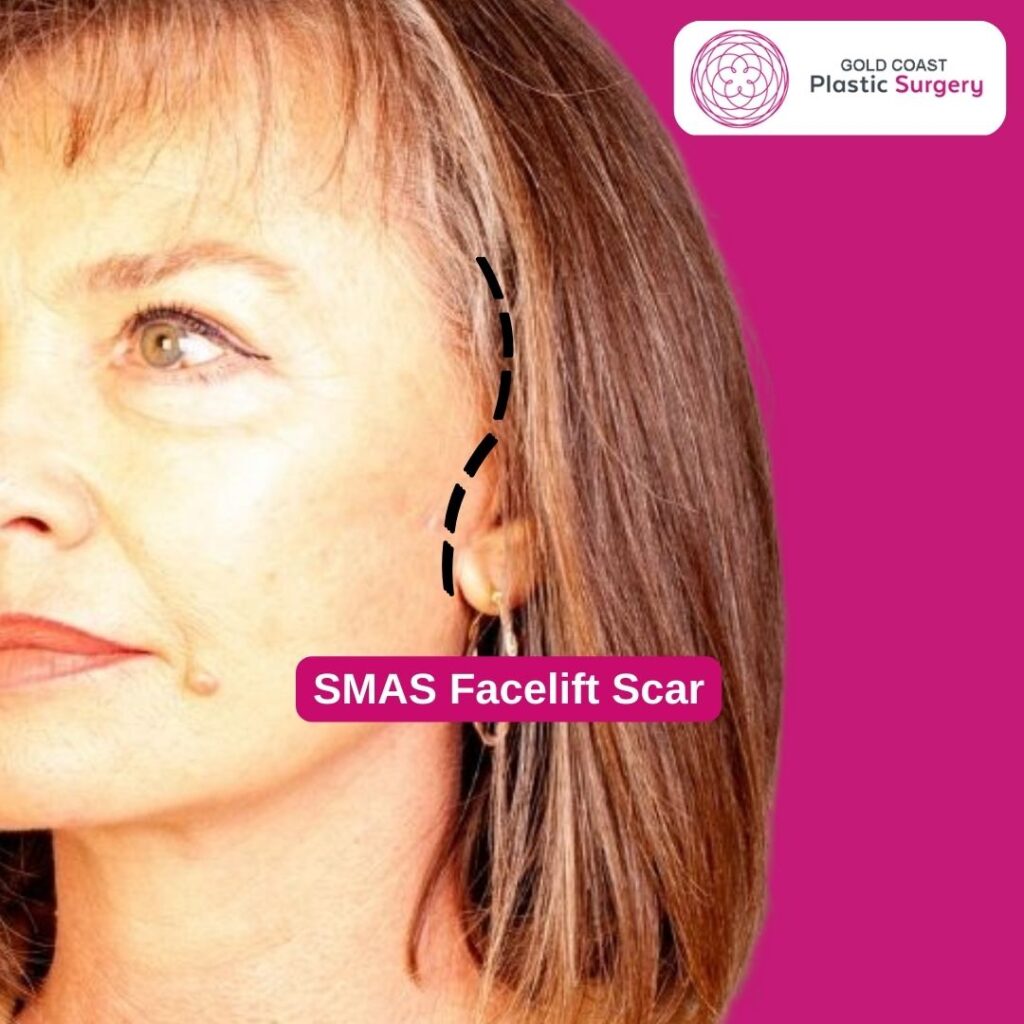 FaceliftScarTypes Gold Coast Plastic Surgery