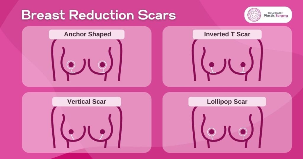 What to Expect During Breast Reduction Recovery