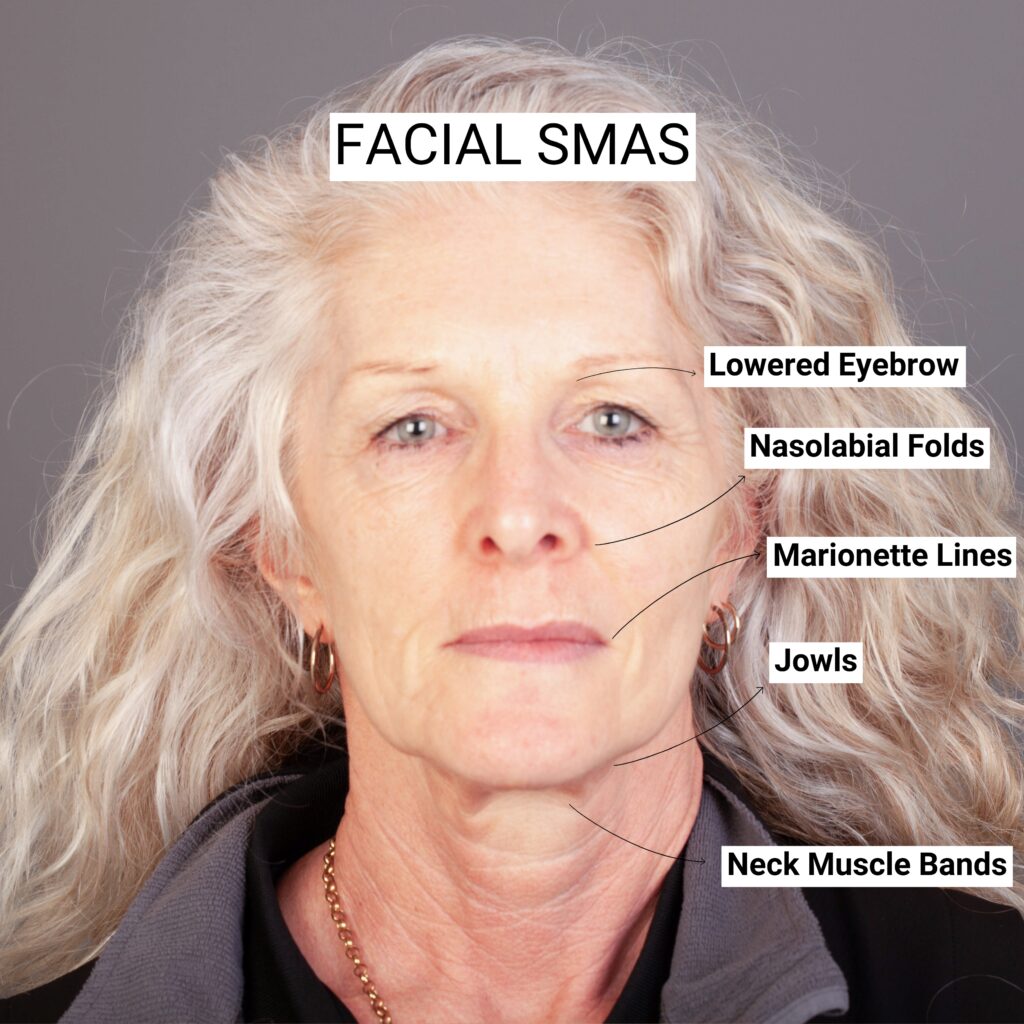Gold Coast and Brisbane Face Lift Surgery by a Specialist Plastic Surgeon
