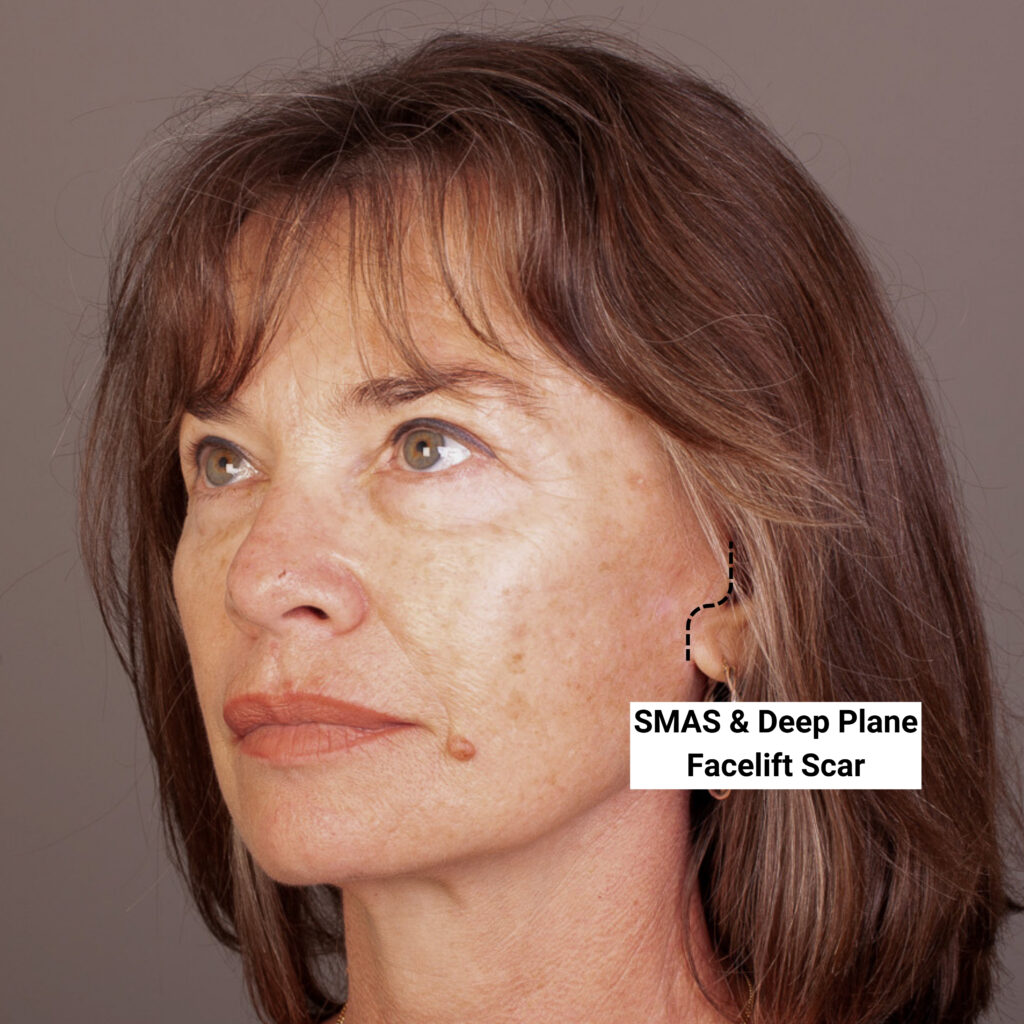 Gold Coast Face Lift Surgery by a Specialist Plastic Surgeon