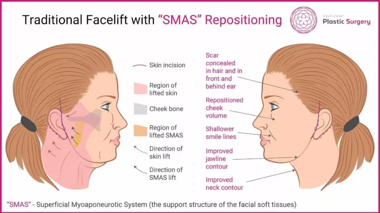 SMAS Face Lift