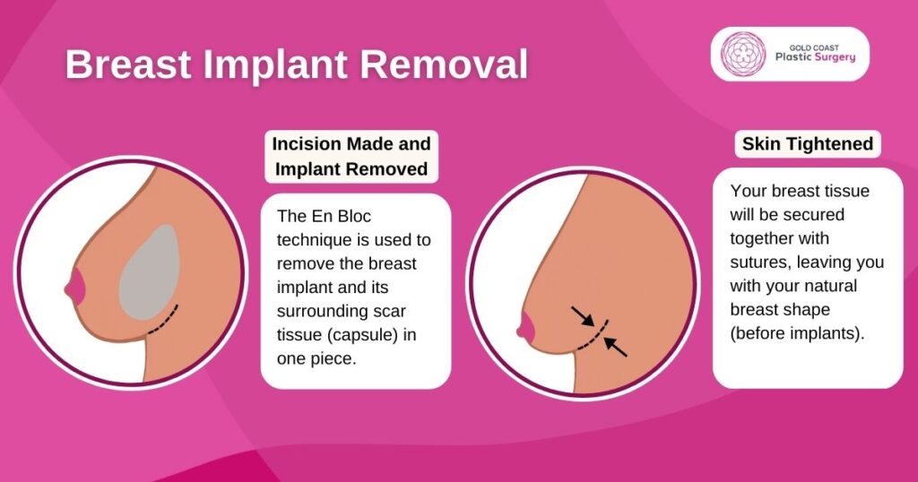 Breast Implant Removal (En bloc)
