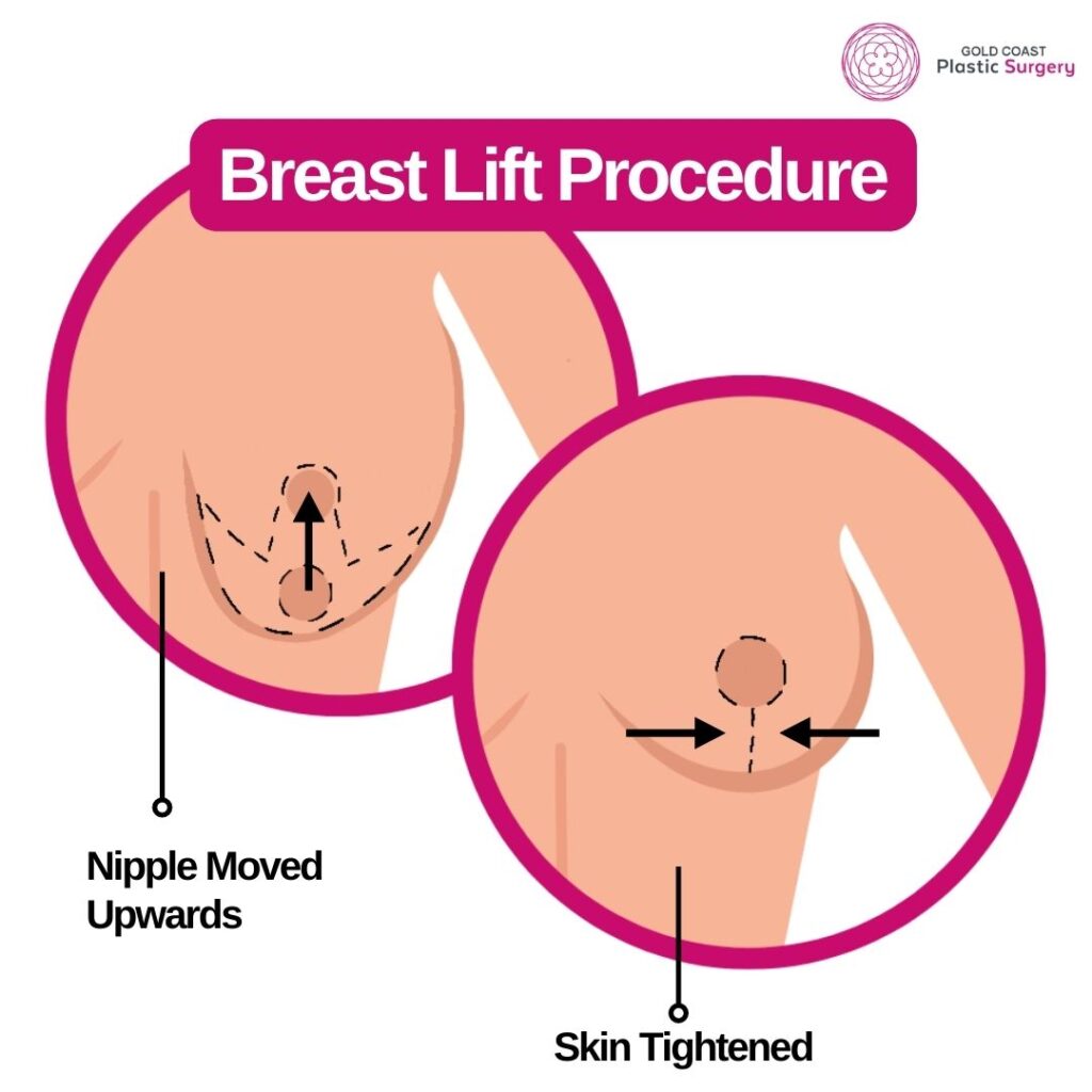 Breast Lift  Dr Mark Doyle Plastic Surgeon