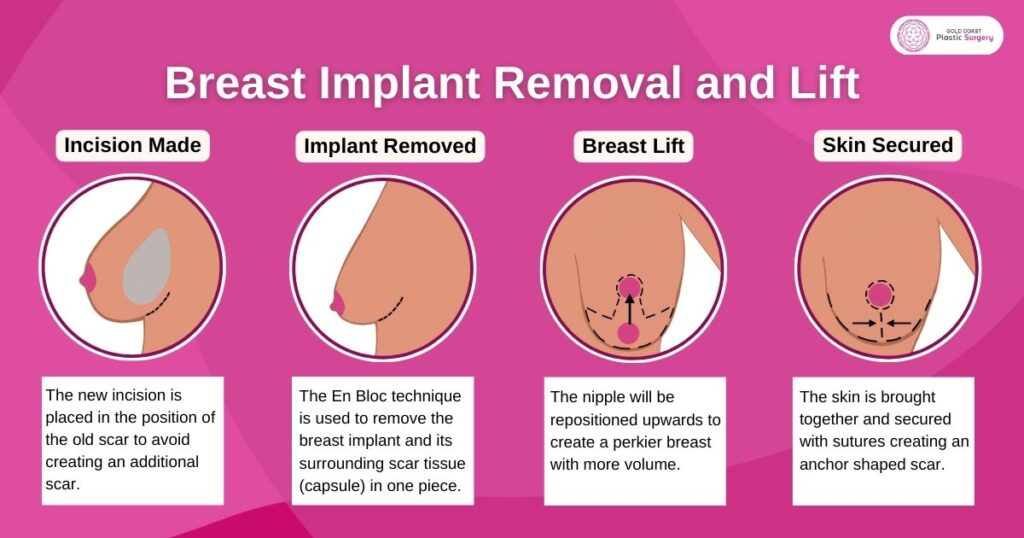 breast implant removal and lift 
