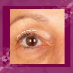 blepharoplasty recovery