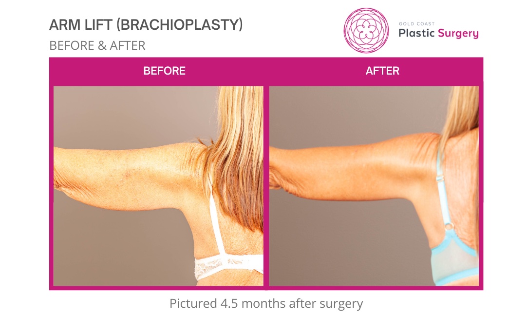 Brachioplasty (Arm Lift): Surgery, Recovery & What To Expect
