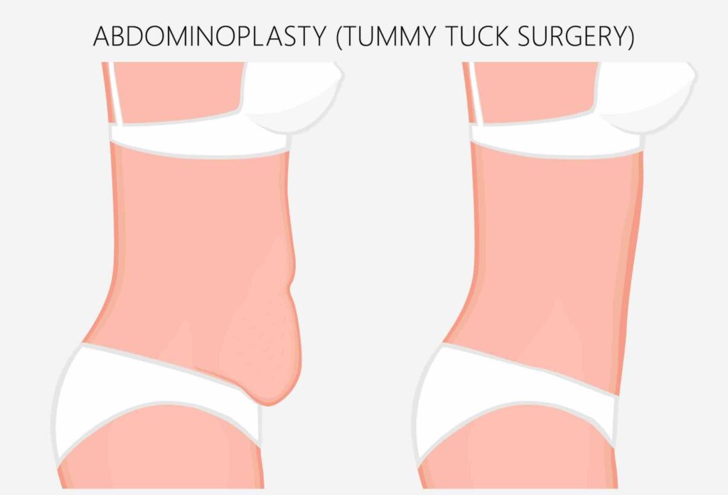 tummy-tuck-after-c-section