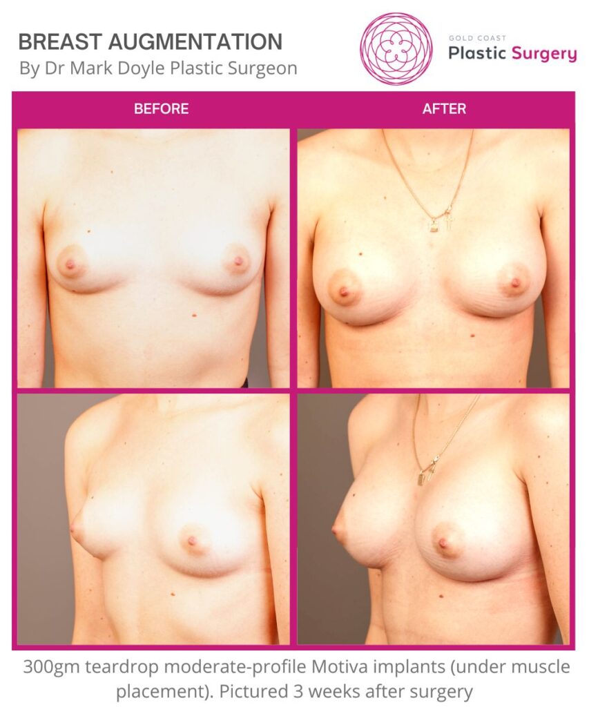 teardrop implants before and after