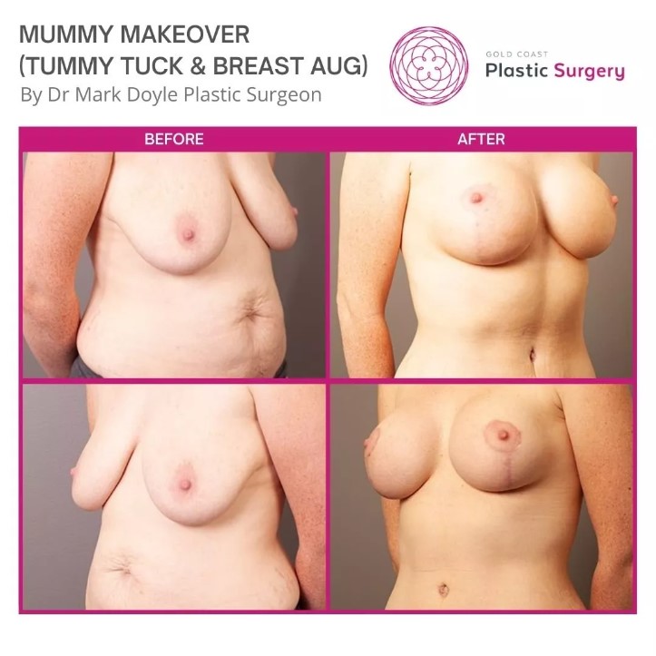 body contouring before after photos