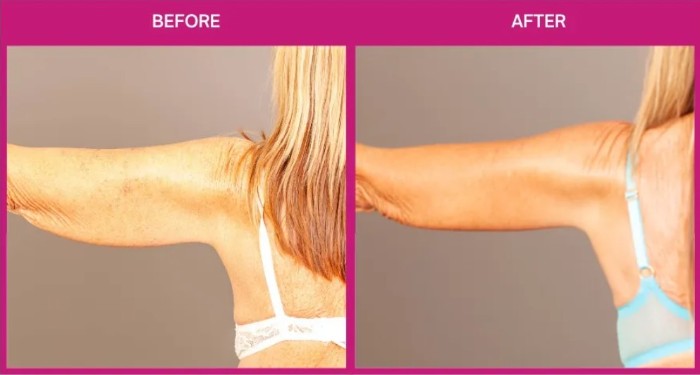body contouring before after photos