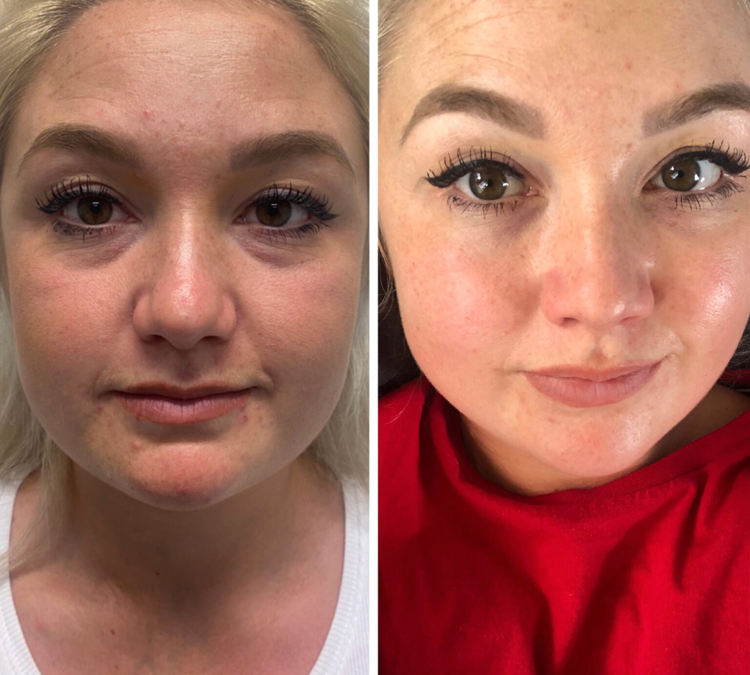 Non Surgical Face Lift