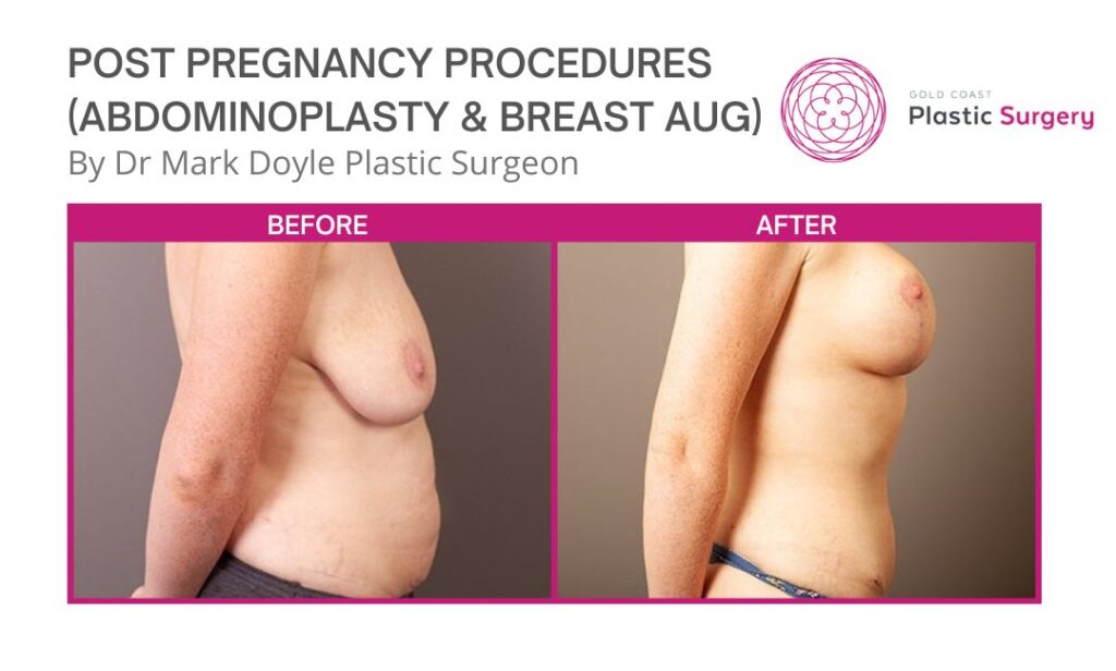 Breast Lift Surgery After Pregnancy