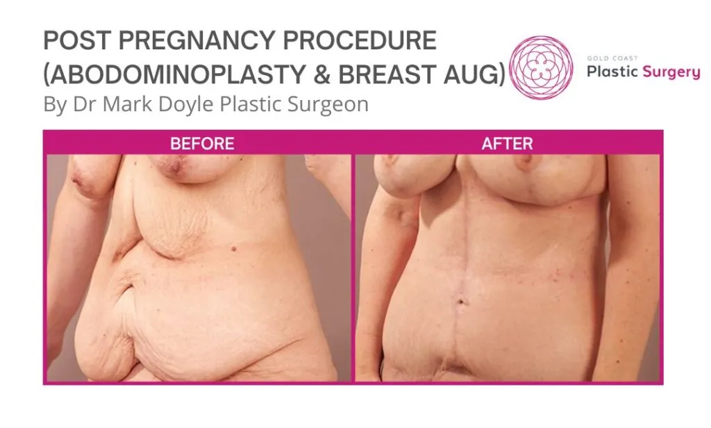 Correct Sagging Breasts Post-Pregnancy with a Breast Lift - Folsom Ca -  Nuance Cosmetic Surgery