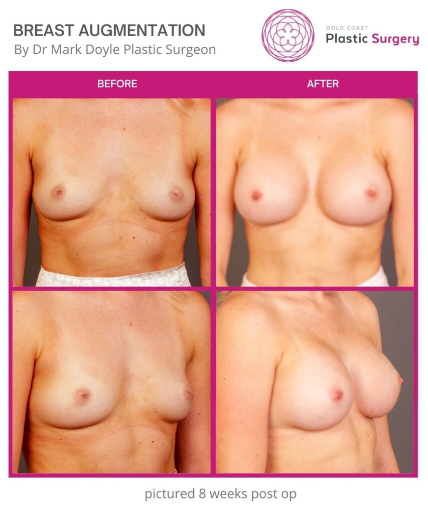 boob job breast augmentation photos