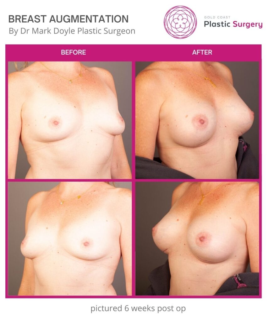 boob job breast augmentation photos