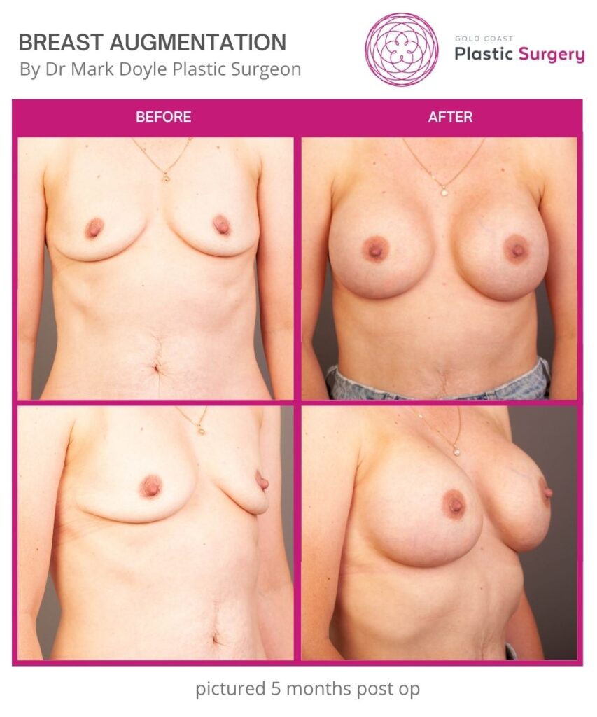 boob job breast augmentation before and after images