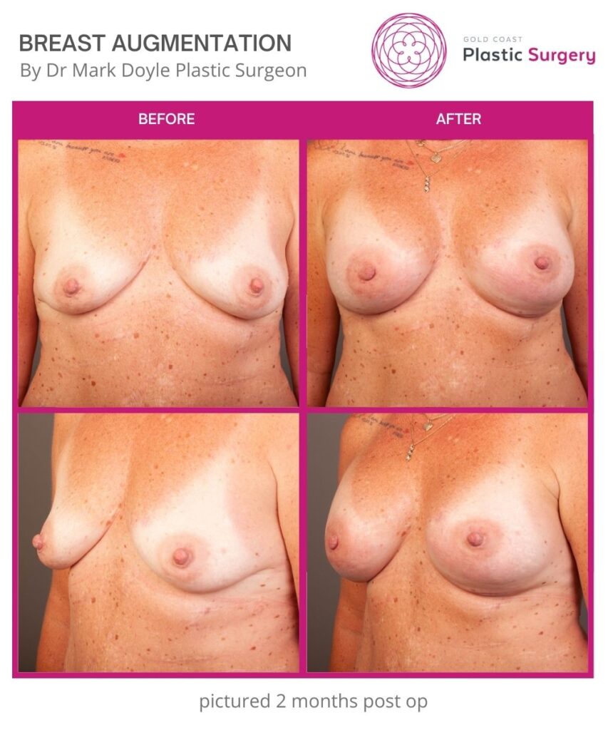 boob job breast augmentation before and after images