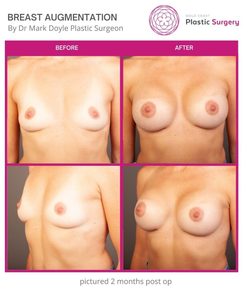 boob job breast augmentation before and after images
