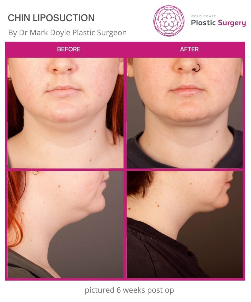 Chin and Neck Liposuction