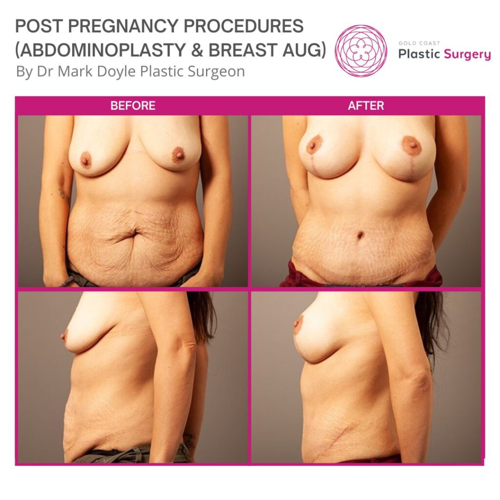 post pregnancy procedures