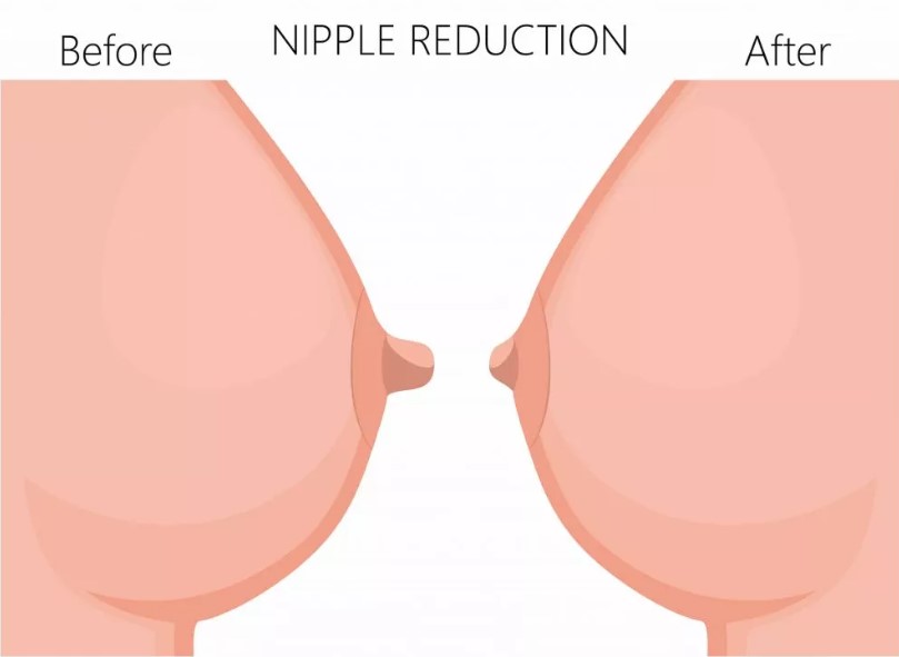 nipple reduction