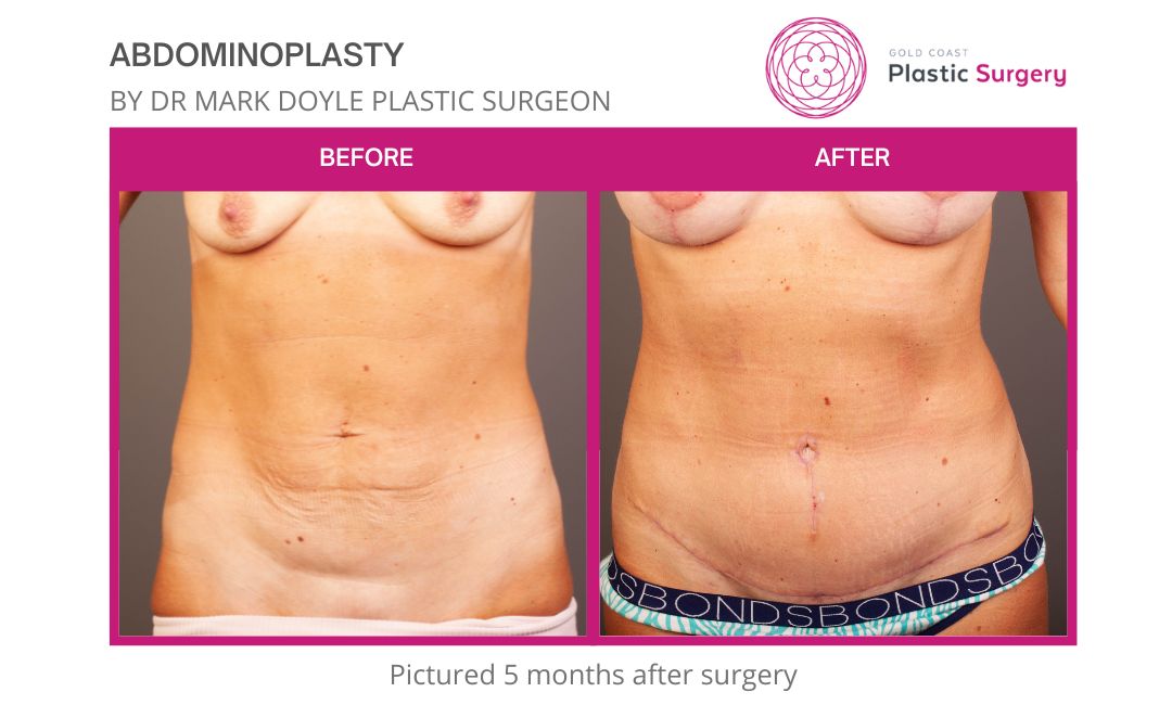Ford Plastic Surgery - The gold standard for abdominal body contouring is  abdominoplasty or tummy tuck surgery with associated liposuction.  Abdominoplasty surgery tightens underlying rectus abdominis muscles to  improve waistline contour and